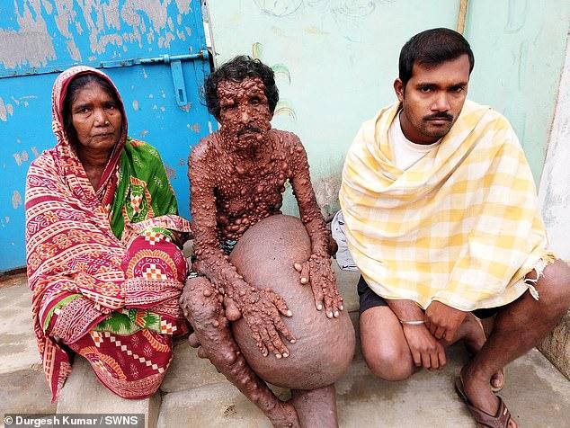 Человек-пузырь из Индии с сотнями опухолей (5 фото)