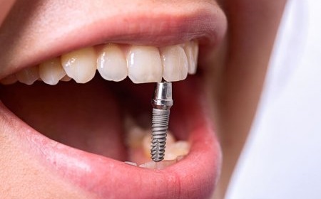 Что собой представляет услуга установки имплантов зубов?