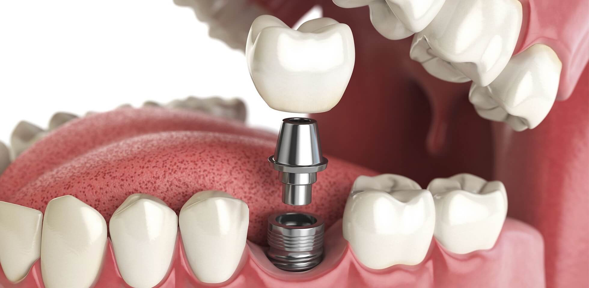 Современная стоматология: когда следует пройти имплантацию зубов?