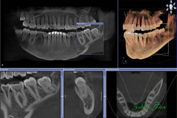 Панорамный снимок зубов и 3D снимок - Отличия