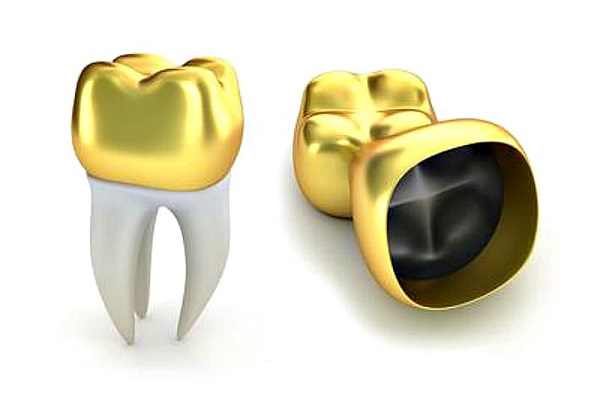 Особенности скупки золотых зубов в ломбард: что нужно знать перед обращением